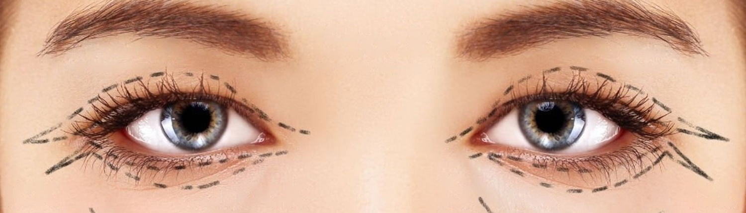 Blépharoplastie blépharoplastie - Dr Paul Seknadje, chirurgien esthétique à Paris