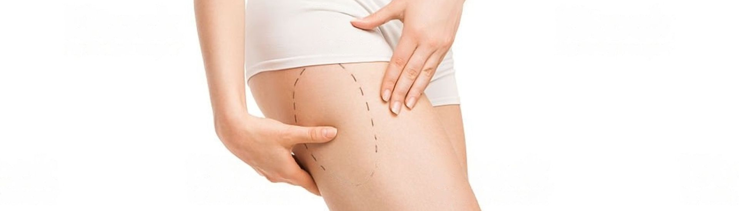 Lifting des cuisses lifting des cuisses - Dr Paul Seknadje, chirurgien esthétique à Paris