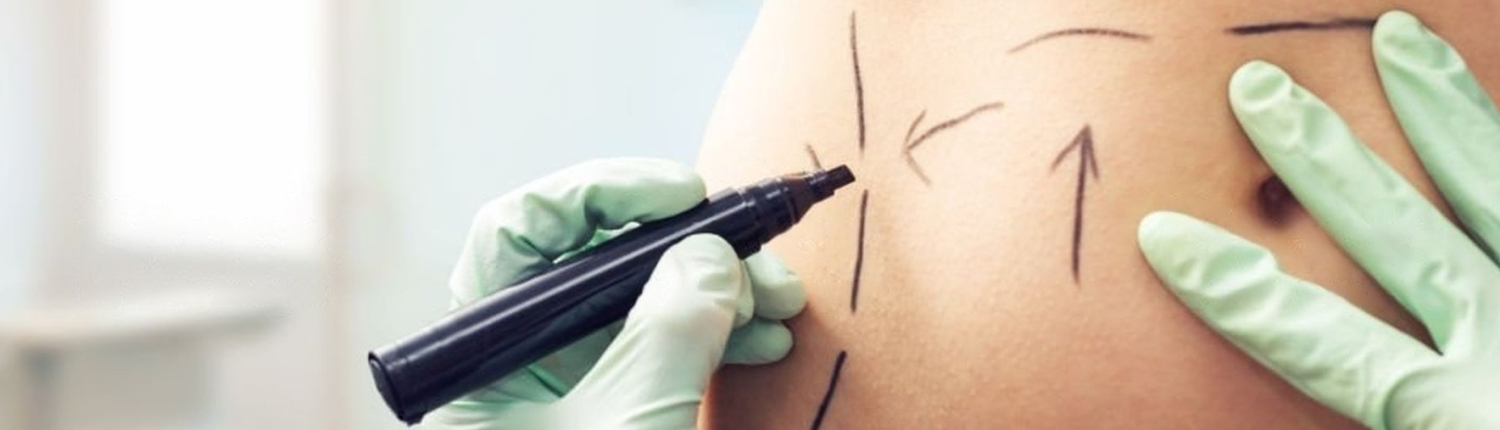 Liposuccion du ventre liposuccion du ventre - Dr Paul Seknadje, chirurgien esthetique a Paris (photo 1)