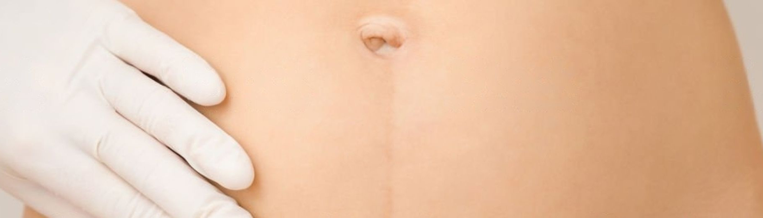 Mini-lifting abdominal mini-lifting abdominal - Dr Paul Seknadje, chirurgien esthétique à Paris