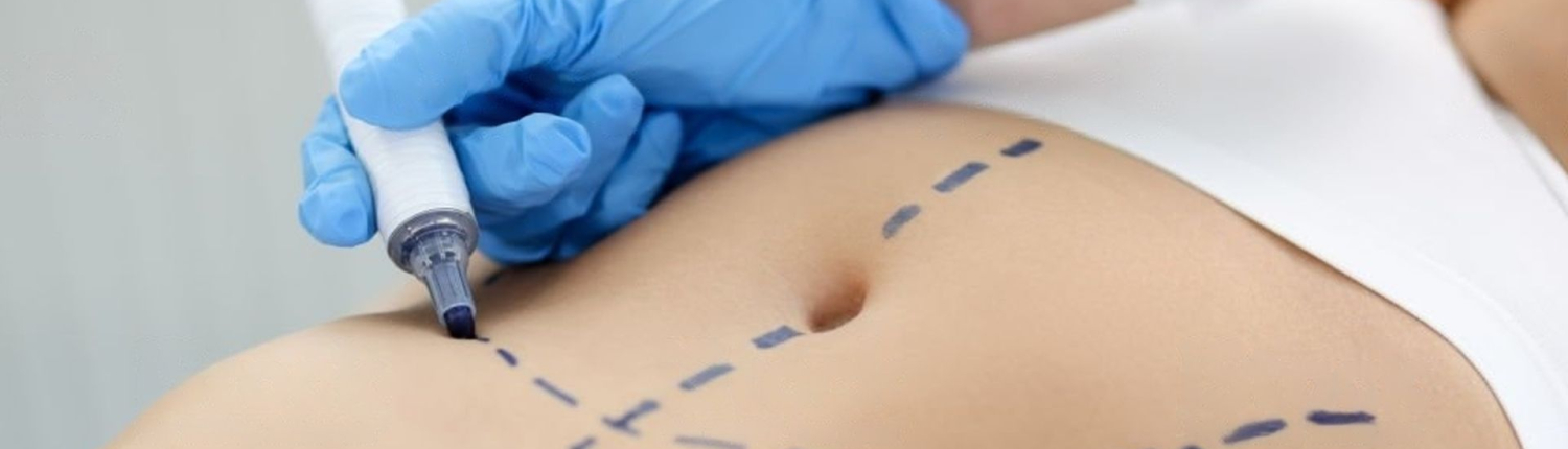 plastie abdominale classique - Dr Paul Seknadje, chirurgien esthétique à Paris